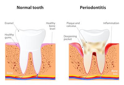 illustration of normal tooth vs tooth with periodontitis