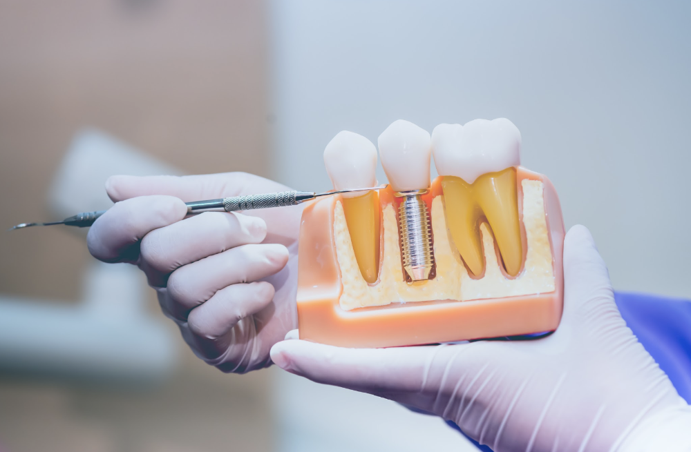 dentist with dental implants model in prahran