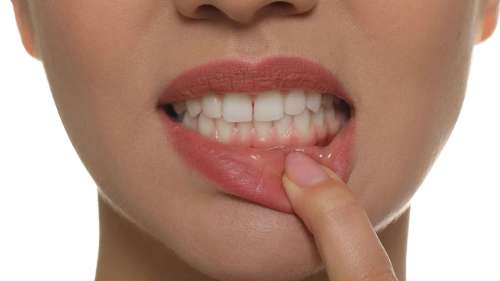 patient considering gum contouring in prahran