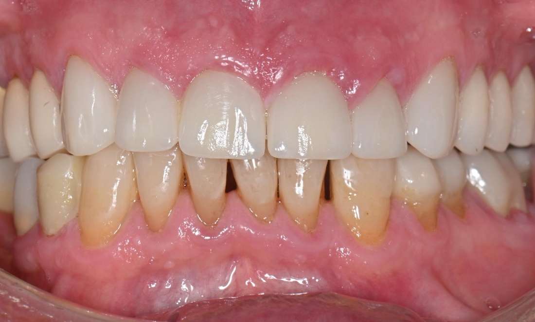worn down teeth are fixed after smile transformation in prahran