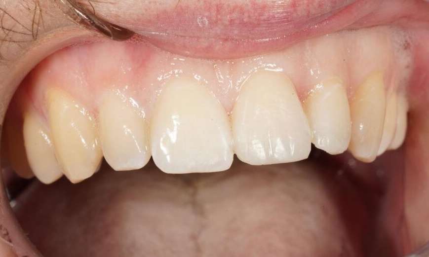 Resin Repair VIC After