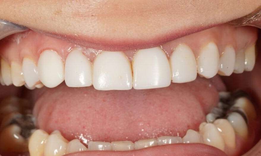 Resin Veneers VIC Lifetime Dental After