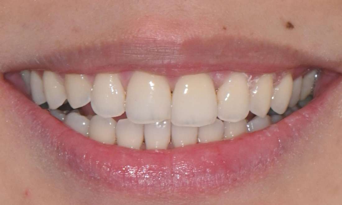 clear aligners results after treatment in prahran