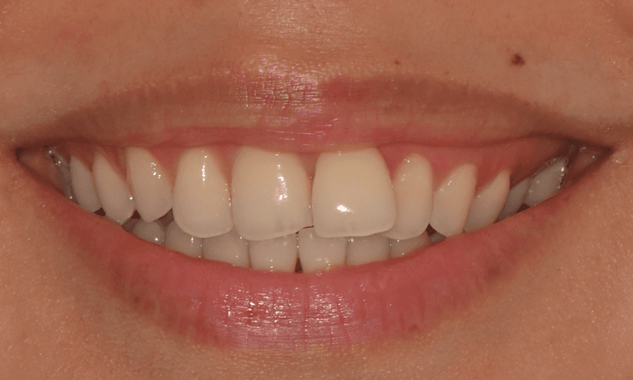clear aligners results before treatment in prahran