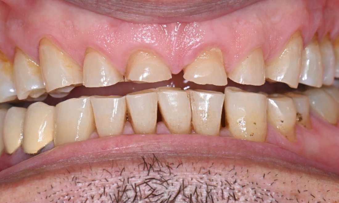 worn down teeth before smile transformation in prahran