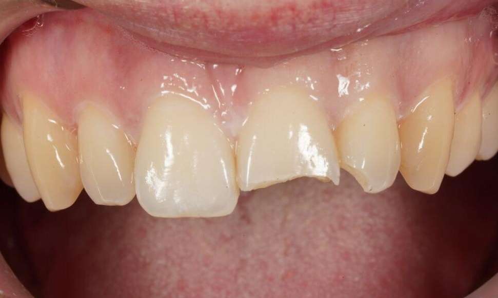 Resin Repair VIC Before