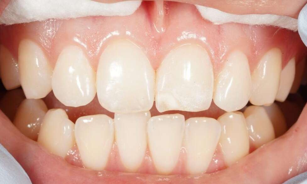 Resin Veneers VIC Before