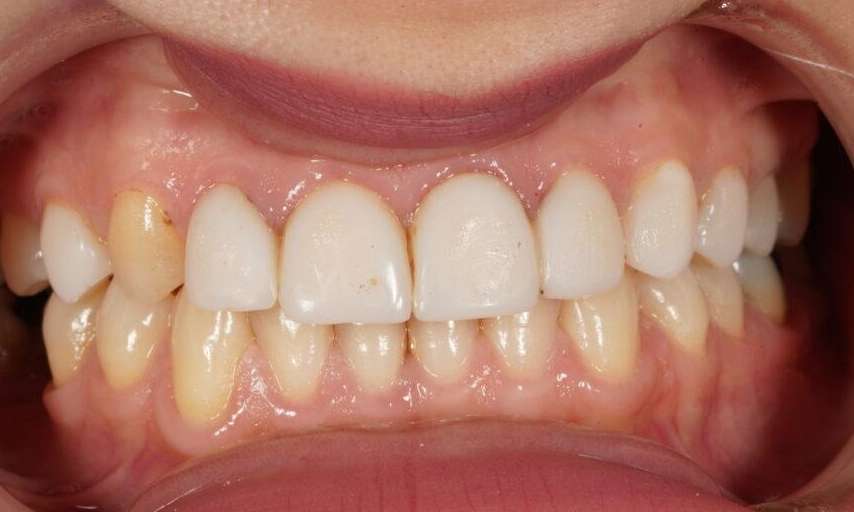 Resin Veneers VIC Lifetime Dental Before