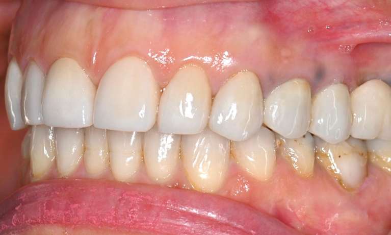 Clear-Aligners-and-Veneers-After-Image