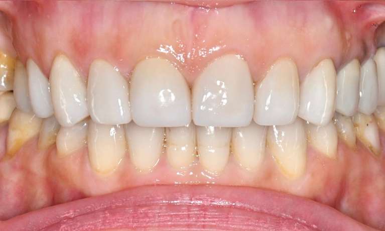 Results-with-Clear-Aligners-and-Veneers-After-Image