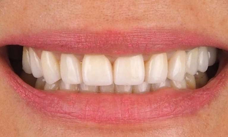after clear aligner treatment and veneers at Lifetime Dental in Prahran