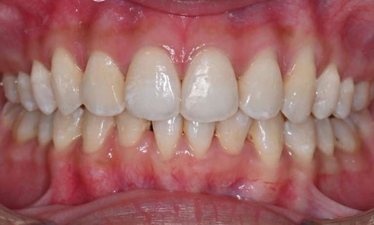 Orthodontic-Treatment-with-Clear-Aligners-After-Image