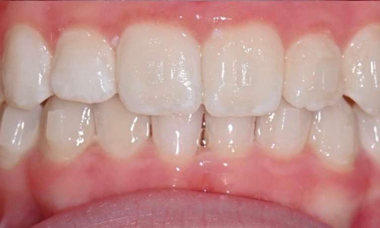 after clear aligner treatment at Lifetime Dental in Prahran