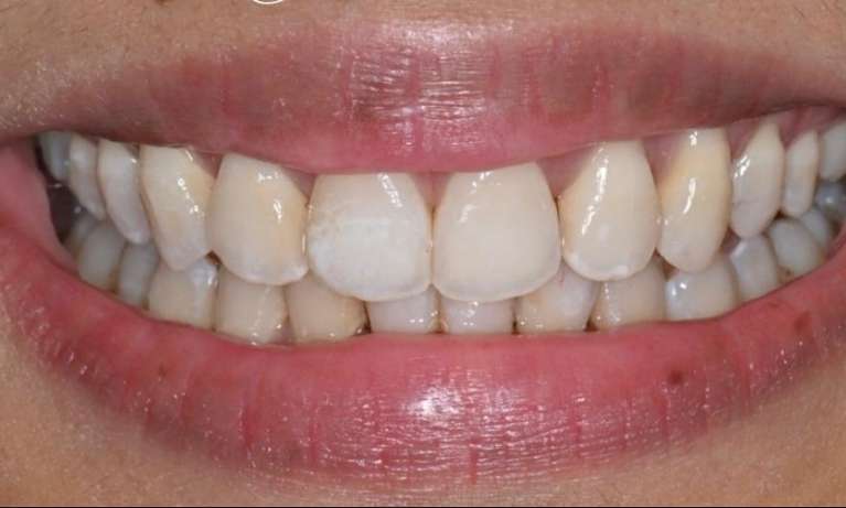 after clear aligner treatment at Lifetime Dental in Prahran