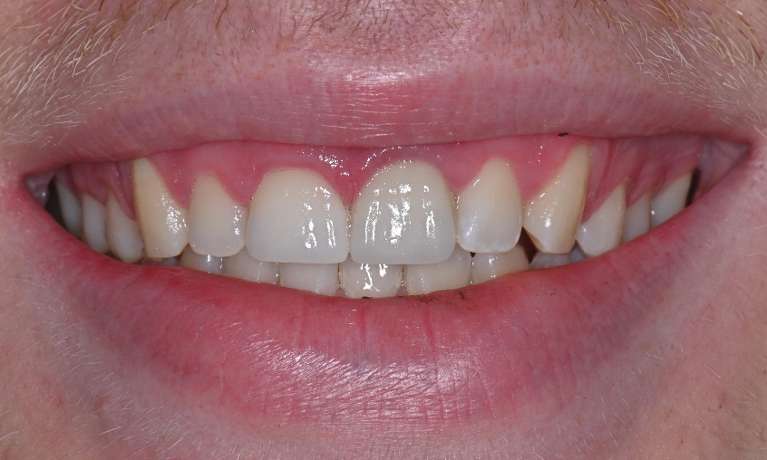 Smile-Restoration-with-Crown-and-Bridge-After-Image