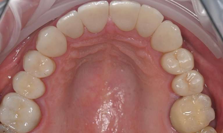 after removal of silver fillings using tooth-coloured fillings in prahran