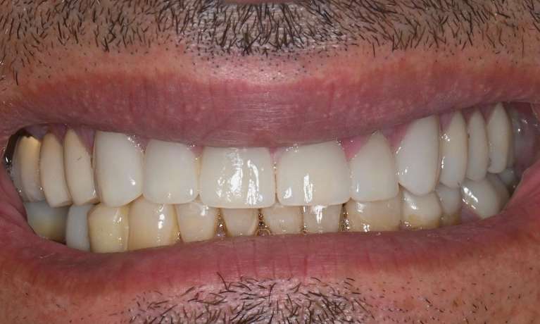 after full mouth rehabilitation at Lifetime Dental in Prahran