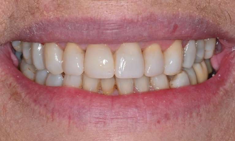 patient after composite veneers in prahran