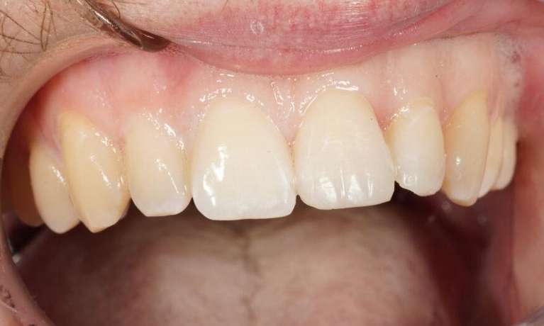 Resin Repair VIC After