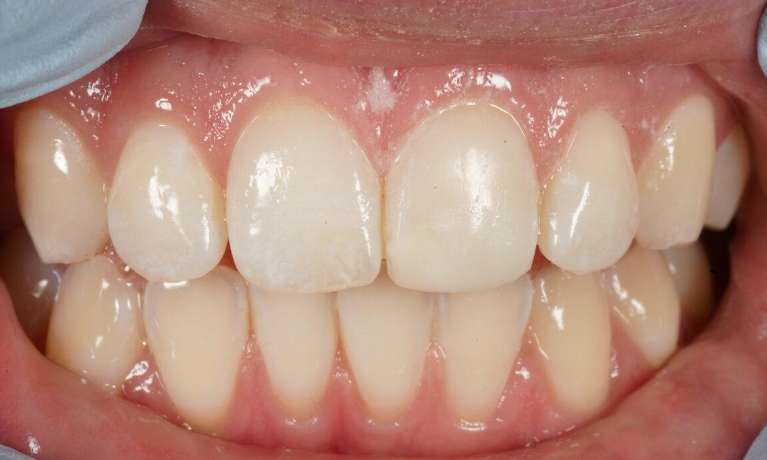 Resin Veneers VIC After