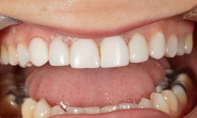 Resin Veneers VIC Lifetime Dental After