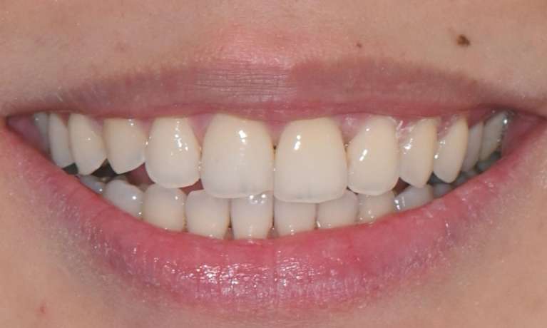 Clear-Aligners-After-Image