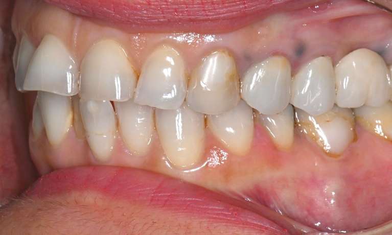 Clear-Aligners-and-Veneers-Before-Image