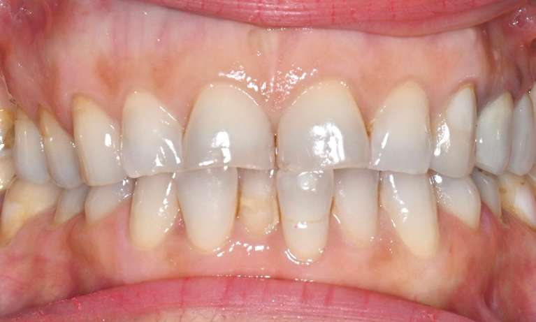 Results-with-Clear-Aligners-and-Veneers-Before-Image