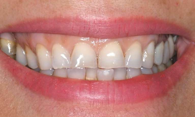 before clear aligner treatment and veneers at Lifetime Dental in Prahran