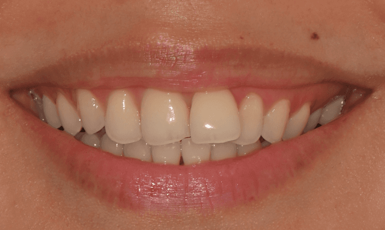 Clear-Aligners-Before-Image