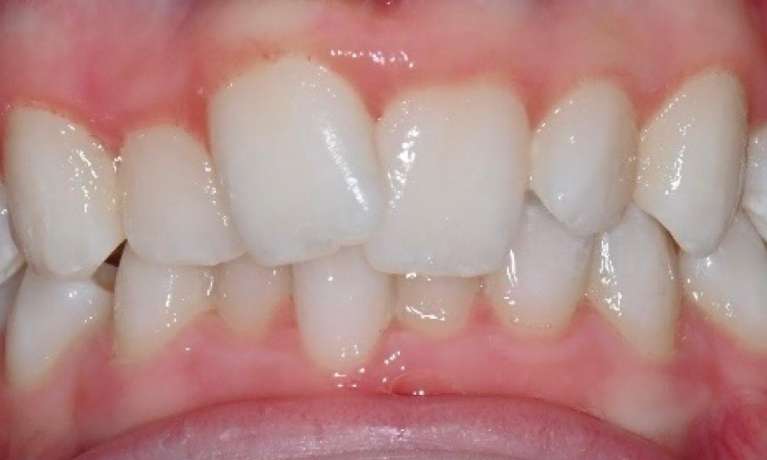 before clear aligner treatment at Lifetime Dental in Prahran