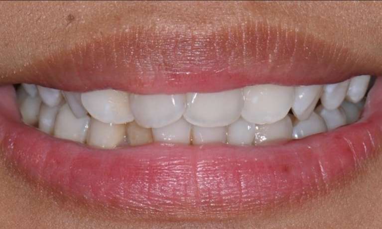 before clear aligner treatment at Lifetime Dental in Prahran