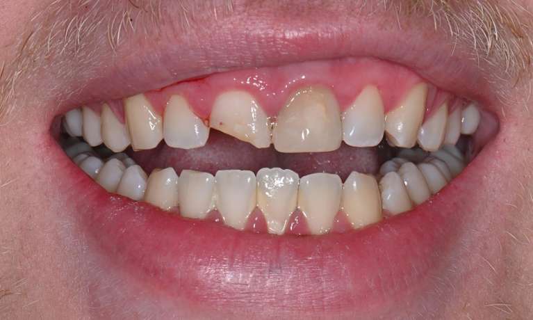 Smile-Restoration-with-Crown-and-Bridge-Before-Image