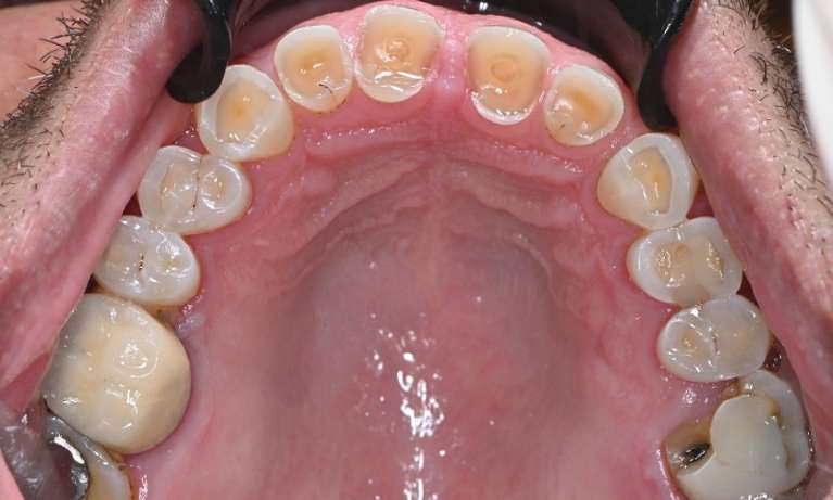 before removal of silver fillings in prahran