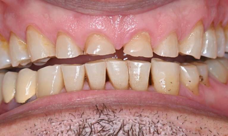 worn down teeth before smile transformation in prahran