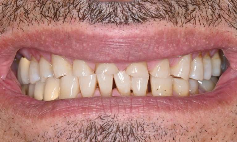 before full mouth rehabilitation at Lifetime Dental in Prahran