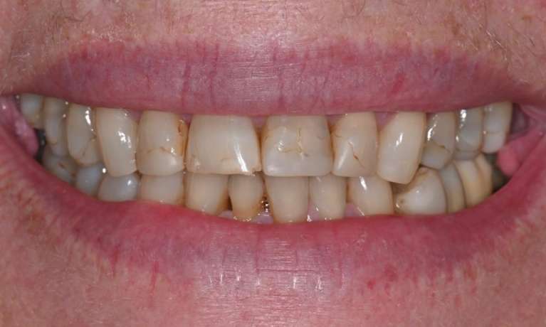 patient before composite veneers in prahran