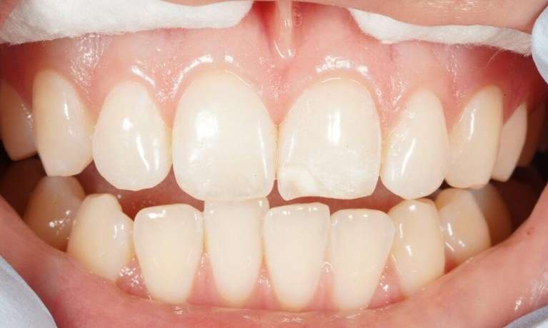 Resin Veneers VIC Before