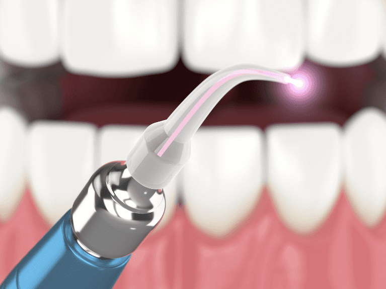 dentist in prahran uses laser dentistry tools