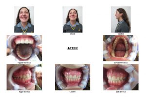 After Non-Extraction Orthodontics