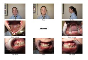 Before Non-Extraction Orthodontics