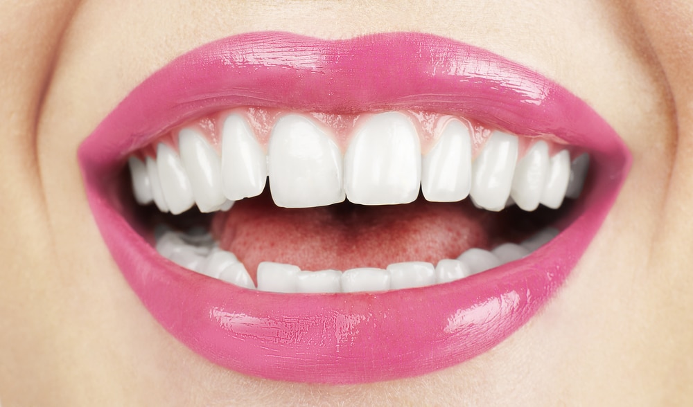 composite teeth dental veneers cost