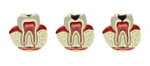 Root canal diagram