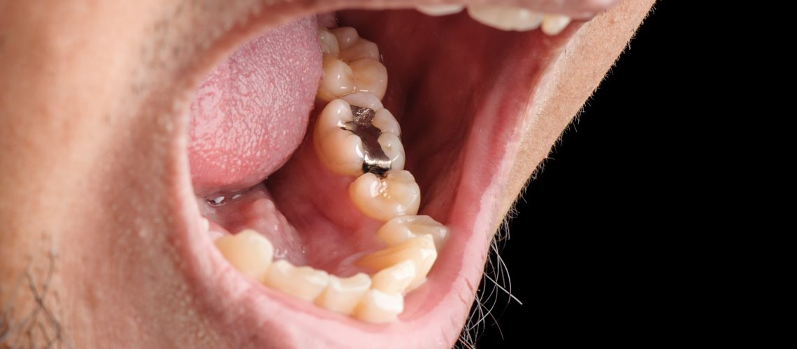 Mouth showing a Mercury Amalgam Dental Filling